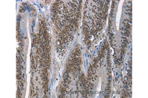 Immunohistochemistry of Human lung cancer using GNRH1 Polyclonal Antibody at dilution of 1:65 (GNRH1 anticorps)