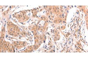 Immunohistochemistry of paraffin-embedded Human lung cancer tissue using TNF beta Polyclonal Antibody at dilution 1:50 (LTA anticorps)