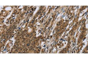 Immunohistochemistry of paraffin-embedded Human gastric cancer using RAP1B Polyclonal Antibody at dilution of 1:50 (RAP1B anticorps)