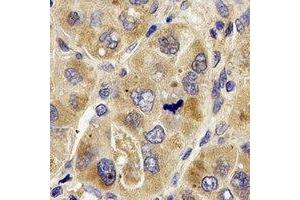 Immunohistochemical analysis of PRODH staining in human liver cancer formalin fixed paraffin embedded tissue section. (PRODH anticorps)