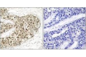 Immunohistochemistry analysis of paraffin-embedded human breast carcinoma, using CDC25C (Phospho-Ser216) Antibody. (CDC25C anticorps  (pSer216))