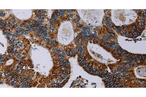 Immunohistochemistry of paraffin-embedded Human colon cancer using NDUFA4 Polyclonal Antibody at dilution of 1:40 (NDUFA4 anticorps)