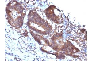 Formalin-fixed, paraffin-embedded human Colon Carcinoma stained with Transgelin Monoclonal Antibody (TAGLN/247) (Transgelin anticorps)