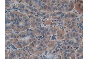 Detection of Hepc in Human Liver cancer Tissue using Polyclonal Antibody to Hepcidin (Hepc)