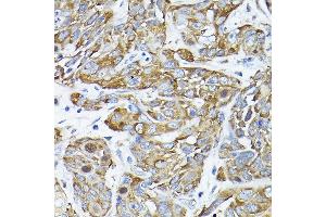 Immunohistochemistry of paraffin-embedded human esophageal cancer using CC2D1A Rabbit pAb (ABIN1679010, ABIN3019218, ABIN3019219 and ABIN6220767) at dilution of 1:200 (40x lens). (CC2D1A anticorps  (AA 1-150))