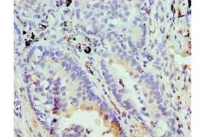 Immunohistochemistry of paraffin-embedded human lung cancer using ABIN7152008 at dilution of 1:100 (Stomatin anticorps  (AA 55-288))