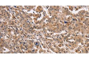 Immunohistochemistry of paraffin-embedded Human liver cancer using KCNG2 Polyclonal Antibody at dilution of 1:40