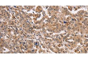 Immunohistochemistry of paraffin-embedded Human liver cancer using KCNG2 Polyclonal Antibody at dilution of 1:40 (Kcng2 anticorps)