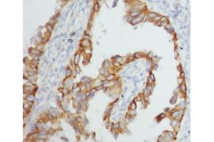 IHC-P: TNF alpha antibody testing of human breast cancer tissue (TNF alpha anticorps  (AA 201-233))