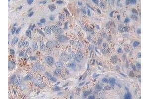 Detection of POSTN in Human Breast cancer Tissue using Polyclonal Antibody to Periostin (POSTN)