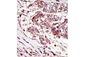 Formalin-fixed and paraffin-embedded human cancer tissue (hepatocarcinoma) reacted with the primary antibody, which was peroxidase-conjugated to the secondary antibody, followed by AEC staining.
