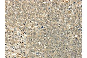 The image on the left is immunohistochemistry of paraffin-embedded Human ovarian cancer tissue using ABIN7128017(SIAH1 Antibody) at dilution 1/35, on the right is treated with fusion protein. (SIAH1 anticorps)