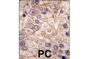 Formalin-fixed and paraffin-embedded human prostate carcinoma tissue reacted with PI4K2B polyclonal antibody  , which was peroxidase-conjugated to the secondary antibody, followed by DAB staining. (PI4K2B anticorps  (N-Term))