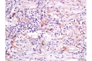 Formalin-fixed and paraffin embedded human lung carcinoma labeled with Anti-GRASP Polyclonal Antibody, Unconjugated  at 1:200 followed by conjugation to the secondary antibody and DAB staining. (Steppke (STEP) (AA 156-260) anticorps)