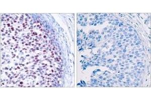 Immunohistochemistry analysis of paraffin-embedded human breast carcinoma, using c-Jun (Phospho-Thr239) Antibody. (C-JUN anticorps  (pThr239))