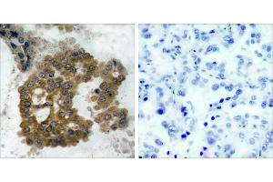 P-Peptide - +Immunohistochemical analysis of paraffin-embedded human lung carcinoma tissue using Akt2 (phospho- Ser474) antibody. (AKT2 anticorps  (pSer474))