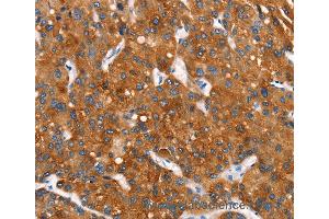 Immunohistochemistry of Human thyroid cancer using MT-CYB Polyclonal Antibody at dilution of 1:30 (Cytochrome b anticorps)
