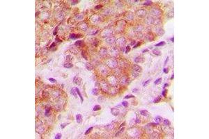 Immunohistochemical analysis of MRPS22 staining in human breast cancer formalin fixed paraffin embedded tissue section.