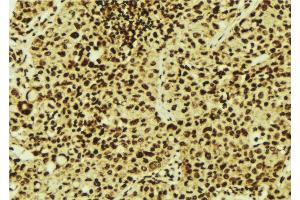 ABIN6277089 at 1/100 staining Human breast cancer tissue by IHC-P.