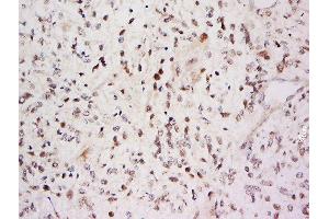 Formalin-fixed and paraffin embedded Glioma cell tumor labeled with Anti-SARA Polyclonal Antibody, Unconjugated  at 1:500 followed by conjugation to the secondary antibody and DAB staining. (ZFYVE9 anticorps  (AA 71-170))