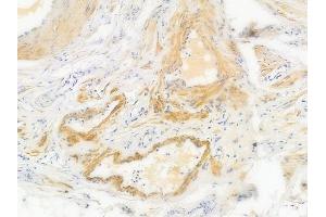 ABIN6256659 and ABIN6267529 at 1/100 staining human testicular cancer by IHC-P.