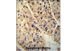 ABCD1 antibody (Center) (ABIN654412 and ABIN2844150) immunohistochemistry analysis in formalin fixed and paraffin embedded human hepatocarcinoma followed by peroxidase conjugation of the secondary antibody and DAB staining.