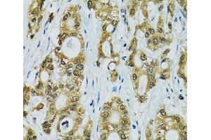Immunohistochemistry of paraffin-embedded Human rectal cancer using RPS7 Polyclonal Antibody at dilution of 1:100 (40x lens).
