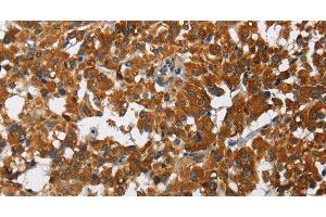 Immunohistochemistry of paraffin-embedded Human thyroid cancer using CAT Polyclonal Antibody at dilution of 1:40 (Catalase anticorps)