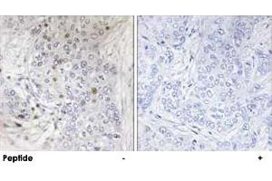 Immunohistochemistry analysis of paraffin-embedded human breast carcinoma tissue, using MAFF polyclonal antibody . (MafF anticorps)
