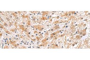 Immunohistochemistry of paraffin-embedded Human liver cancer tissue using PDCL2 Polyclonal Antibody at dilution of 1:65(x200) (PDCL2 anticorps)