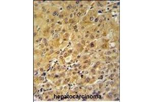 FKBP1A Antibody (C-term) (ABIN1882082 and ABIN2841885) IHC analysis in formalin fixed and paraffin embedded human hepatocarcinoma followed by peroxidase conjugation of the secondary antibody and DAB staining.