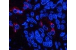 Immunofluorescence analysis of Human lung cancer tissue using LTF Monoclonal Antibody at dilution of 1:200.