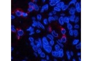 Immunofluorescence analysis of Human lung cancer tissue using LTF Monoclonal Antibody at dilution of 1:200. (Lactoferrin anticorps)
