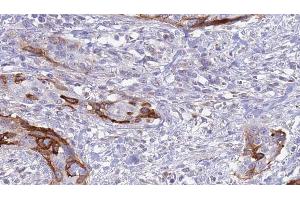 ABIN6273628 at 1/100 staining Human urothelial cancer tissue by IHC-P.