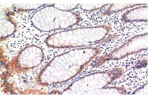 Immunohistochemistry of paraffin-embedded Human colon carcinoma tissue with Phospho-MLKL (Ser358) Monoclonal Antibody at dilution of 1:200