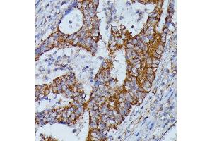 Immunohistochemistry of paraffin-embedded human colon carcinoma using HMGCS2 antibody (ABIN7265329) at dilution of 1:100 (40x lens).