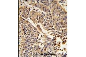 Formalin-fixed and paraffin-embedded human lung carcinoma reacted with JUP Antibody (C-term), which was peroxidase-conjugated to the secondary antibody, followed by DAB staining.