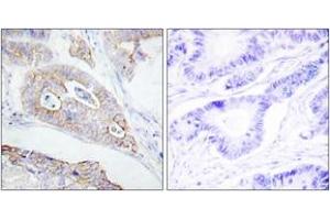 Immunohistochemistry analysis of paraffin-embedded human colon carcinoma tissue, using CD45 (Ab-1007) Antibody.