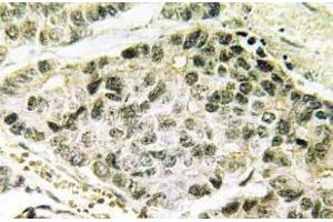 Immunohistochemistry (IHC) analyzes of p-SNAI 1 antibody in paraffin-embedded human lung carcinoma tissue. (SNAIL anticorps  (pSer246))