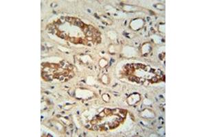 Formalin fixed and paraffin embedded human lung tissue reacted with PPM1L Antibody (C-term) followed by peroxidase conjugation of the secondary antibody and DAB staining.