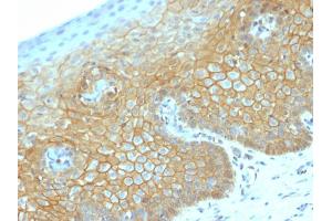 Formalin-fixed, paraffin-embedded human Cervical Carcinoma stained with Beta-Catenin Recombinant Rabbit Monoclonal Antibody (CTNNB1/2030R).