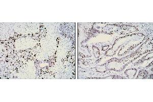 Immunohistochemical analysis of paraffin-embedded lung cancer (left) and rectal cancer (right) using KI67 mouse mAb with DAB staining. (Ki-67 anticorps)