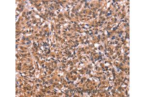 Immunohistochemistry of Human liver cancer using ESRRB Polyclonal Antibody at dilution of 1:40 (ESRRB anticorps)