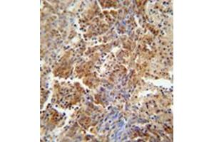 Formalin fixed and paraffin embedded human lung carcinoma reacted with ERCC8 Antibody  followed by peroxidase conjugation of the secondary antibody and DAB staining. (ERCC8 anticorps  (Middle Region))