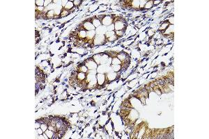 Immunohistochemistry of paraffin-embedded human colon using COX2/PTGS2 Rabbit pAb (ABIN6130125, ABIN6146415, ABIN6146417 and ABIN6216190) at dilution of 1:50 (40x lens). (PTGS2 anticorps  (AA 375-604))