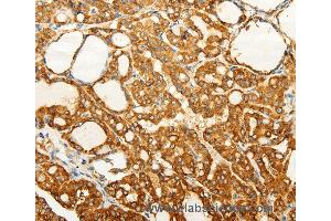 Immunohistochemistry of Human gastric cancer using FZD6 Polyclonal Antibody at dilution of 1:60 (FZD6 anticorps)