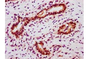 IHC image of ABIN7127756 diluted at 1:100 and staining in paraffin-embedded human breast cancer performed on a Leica BondTM system.