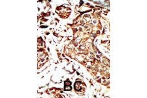 Formalin-fixed and paraffin-embedded human cancer tissue reacted with BRD3 polyclonal antibody  , which was peroxidase-conjugated to the secondary antibody, followed by AEC staining. (BRD3 anticorps  (C-Term))