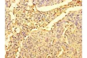 Immunohistochemistry of paraffin-embedded human cervical cancer using ABIN7175093 at dilution of 1:100 (UPRT anticorps  (AA 1-309))