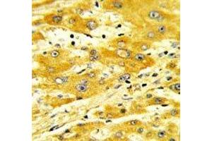 IHC analysis of FFPE human hepatocarcinoma with CD36 antibody